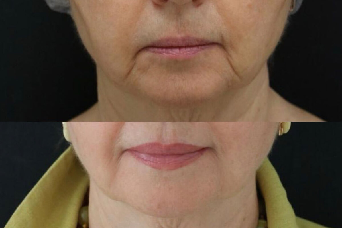 Ulthera System Альтера-терапия 01