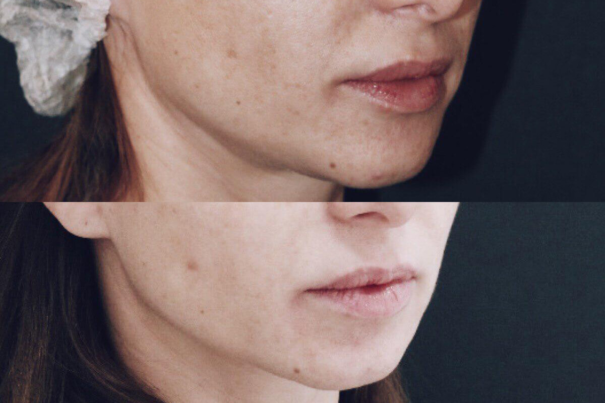 Ulthera System Альтера-терапия 01