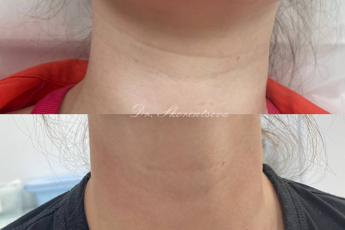 Контурная пластика лица 01