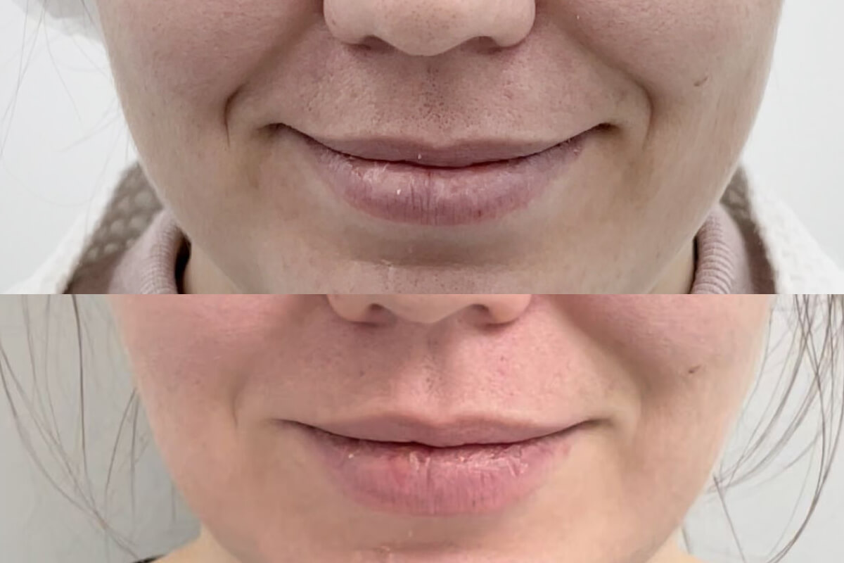 Ботулинотерапия 01