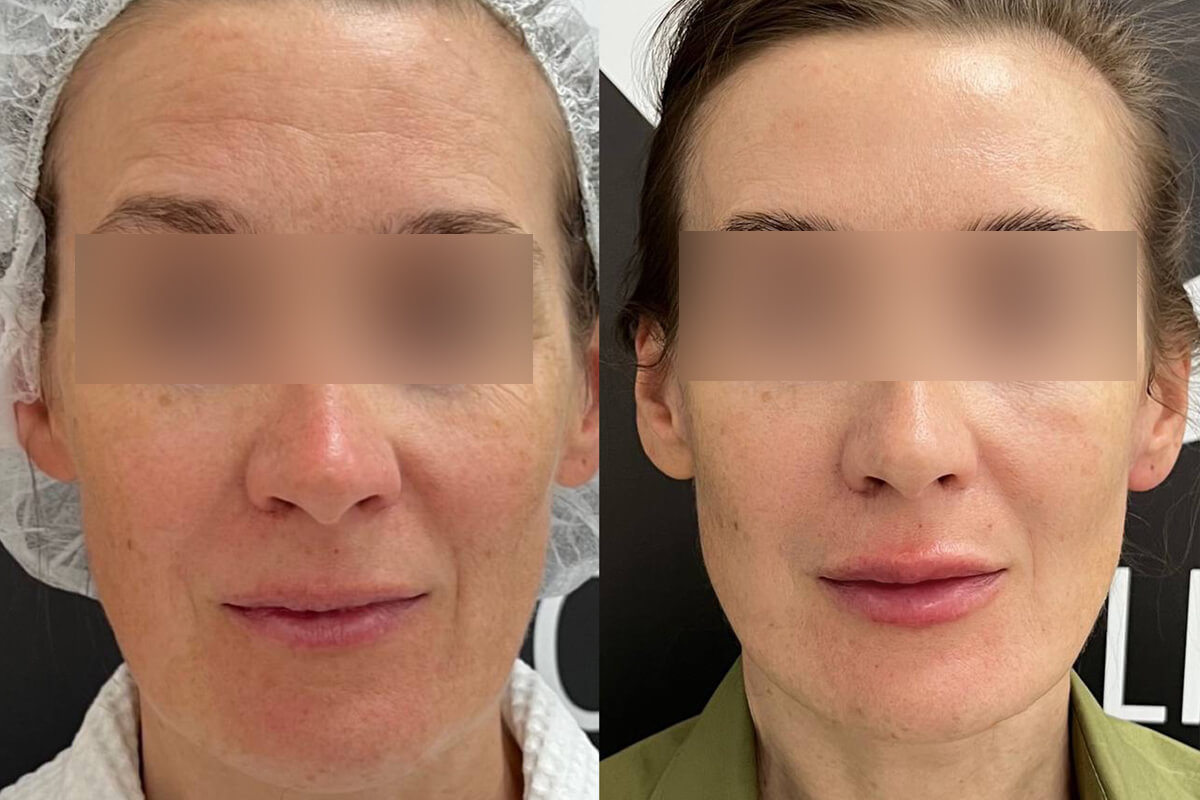 Ботулинотерапия 01