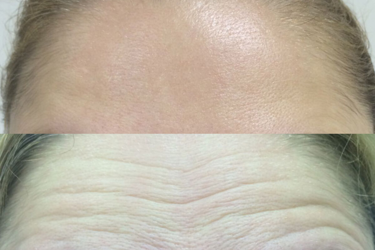 Ботулинотерапия 01