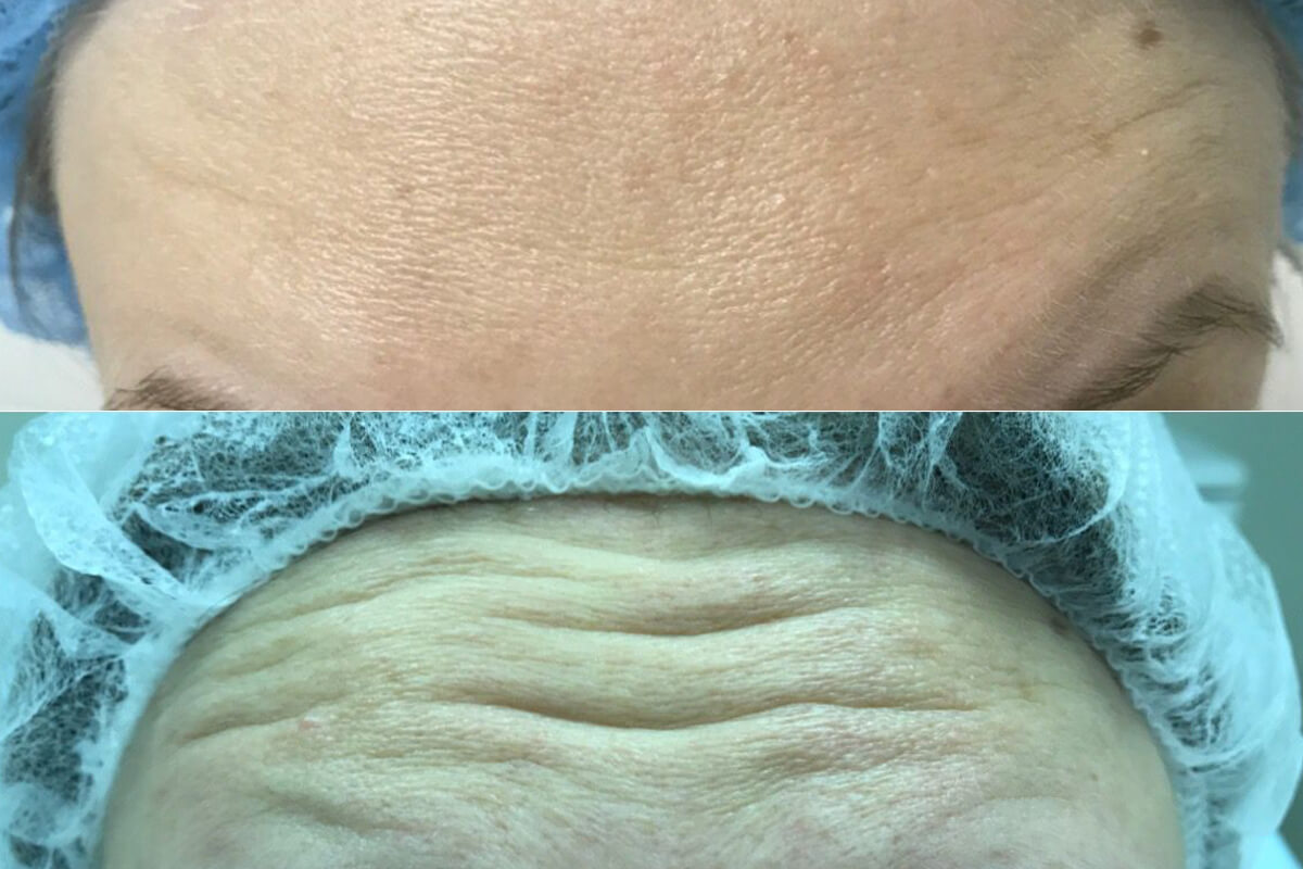 Ботулинотерапия 01