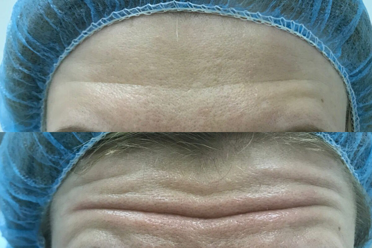 Ботулинотерапия 01