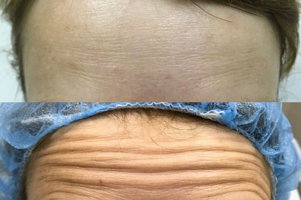 Ботулинотерапия 01