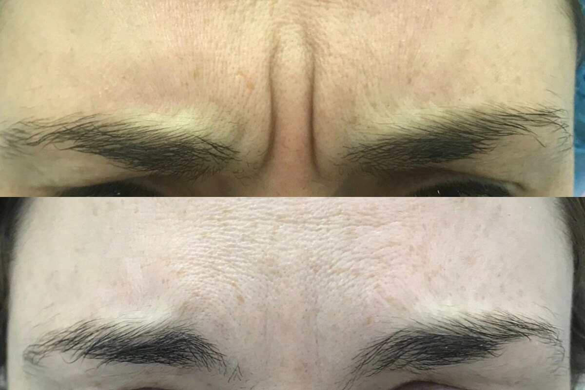 Ботулинотерапия 01