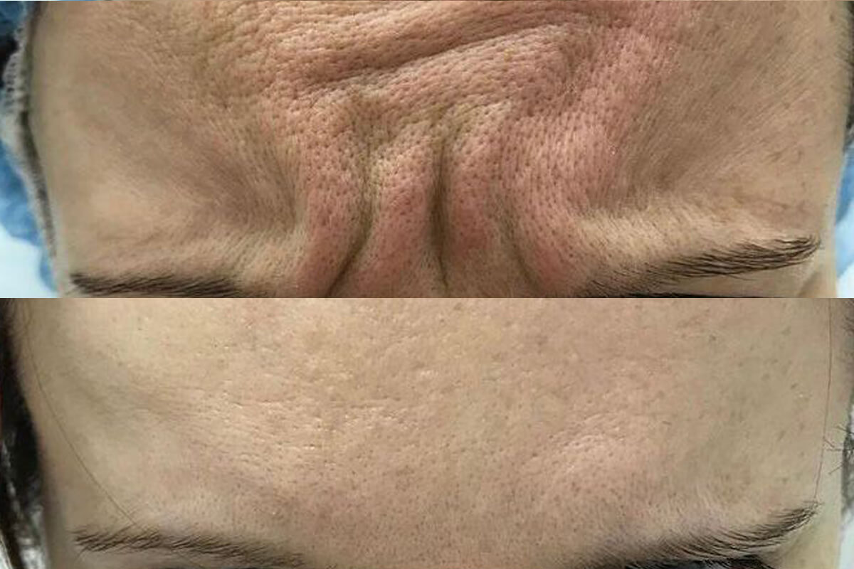 Ботулинотерапия 01