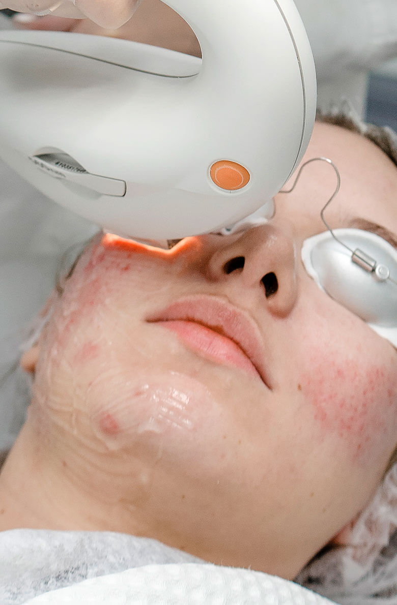 Фотоомоложение М22