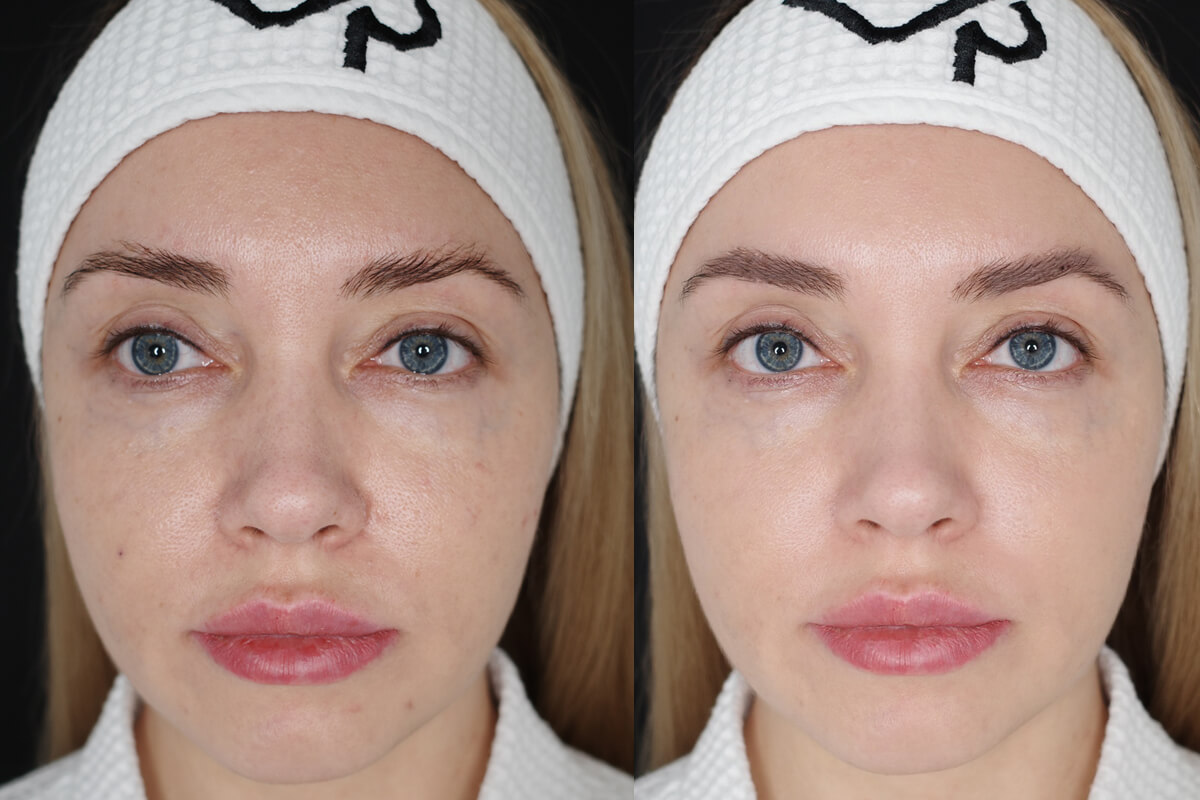 Фотодинамическая терапия Heleo-4 01