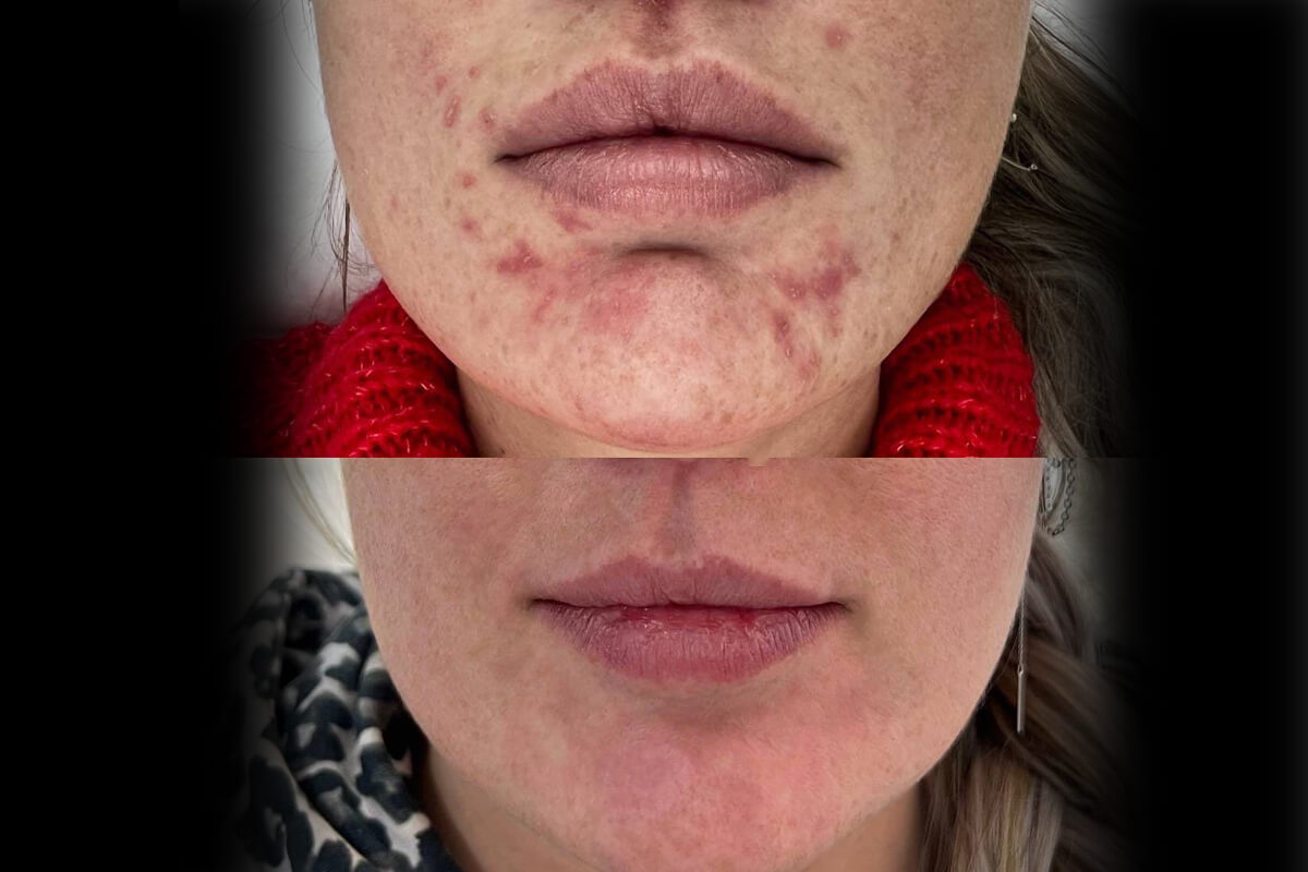 Фотодинамическая терапия Heleo-4 01