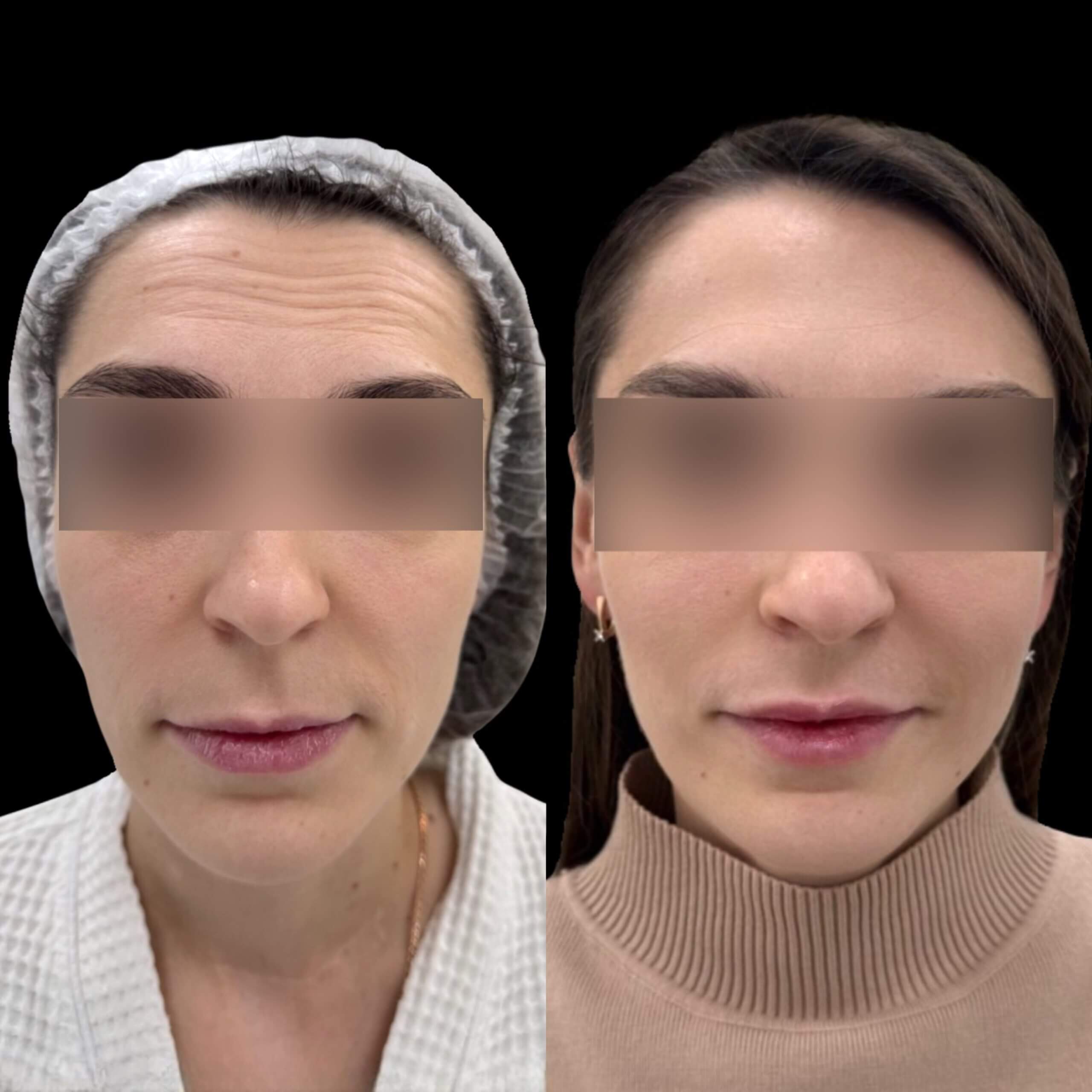 Контурная пластика лица 01