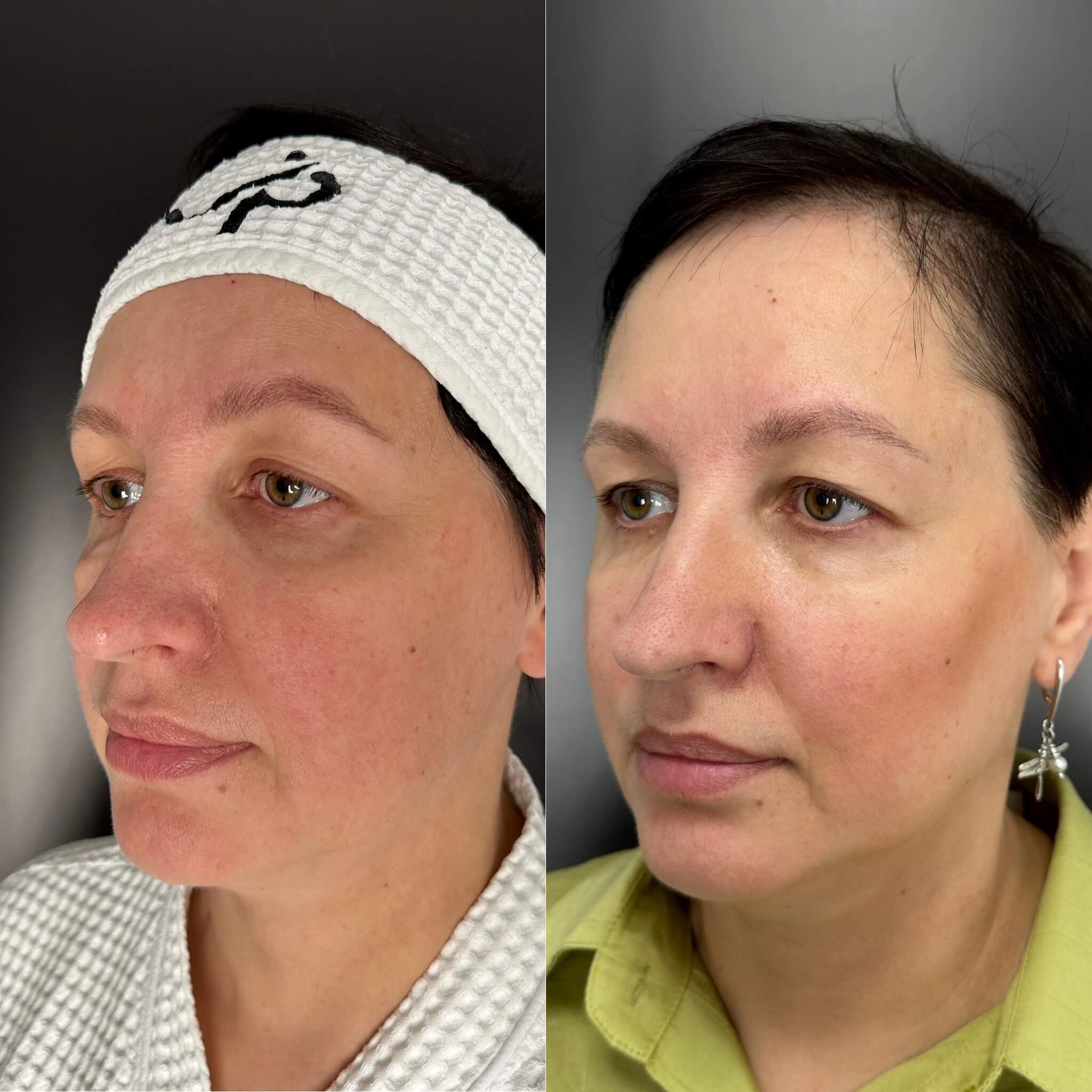 Контурная пластика лица 01