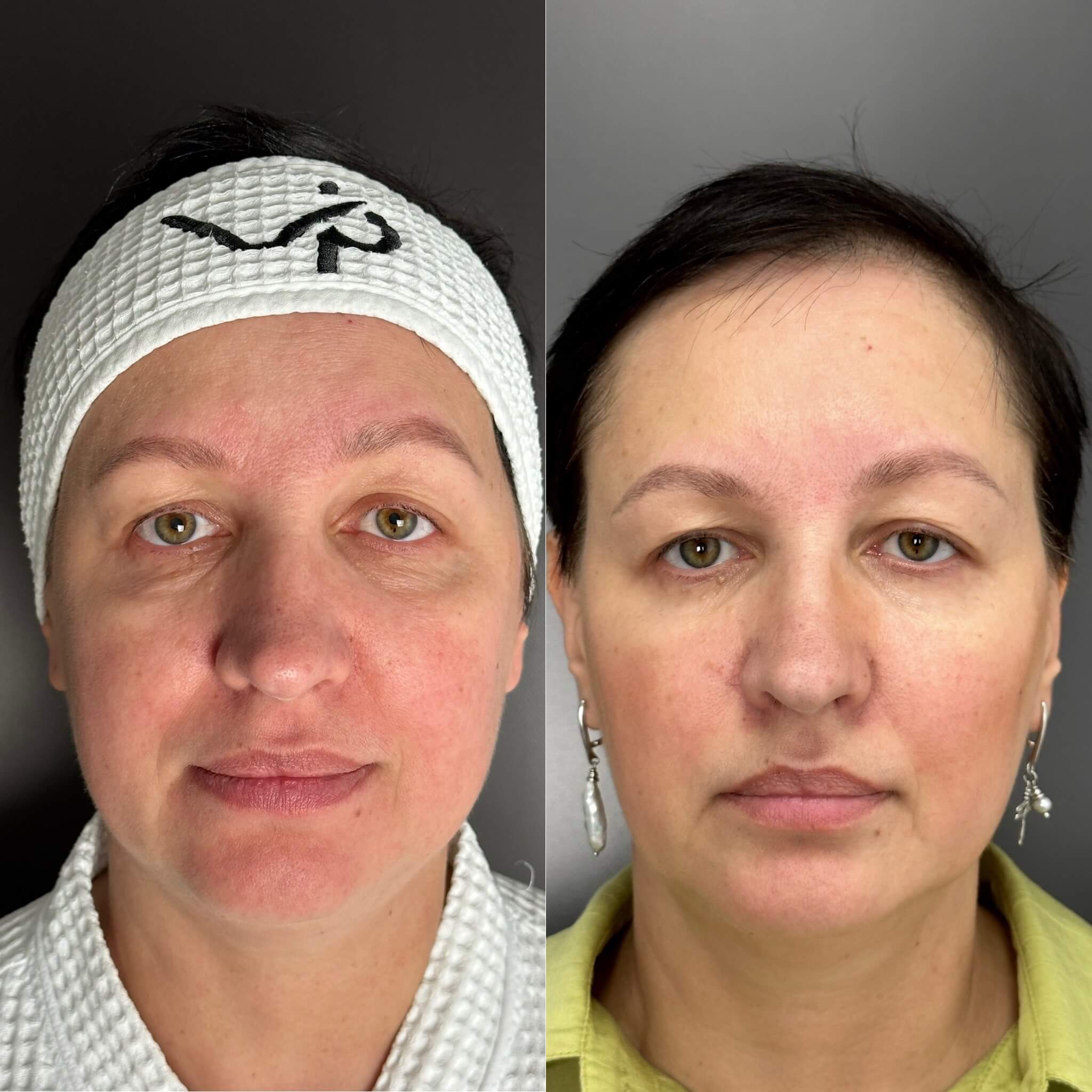 Контурная пластика лица 01