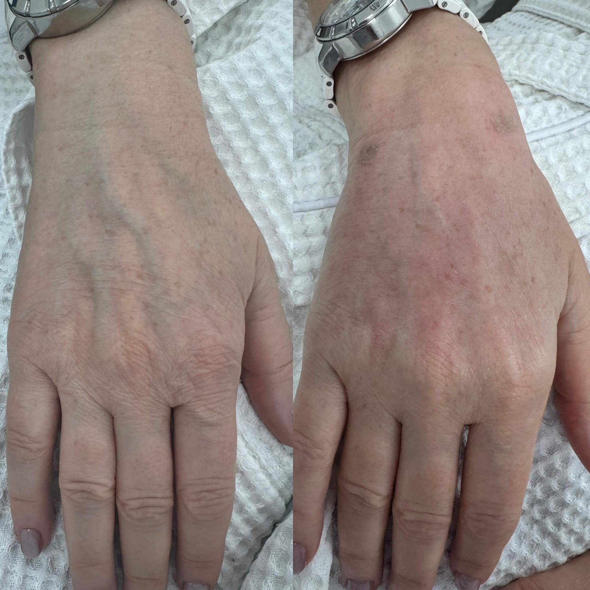 Контурная пластика лица 01