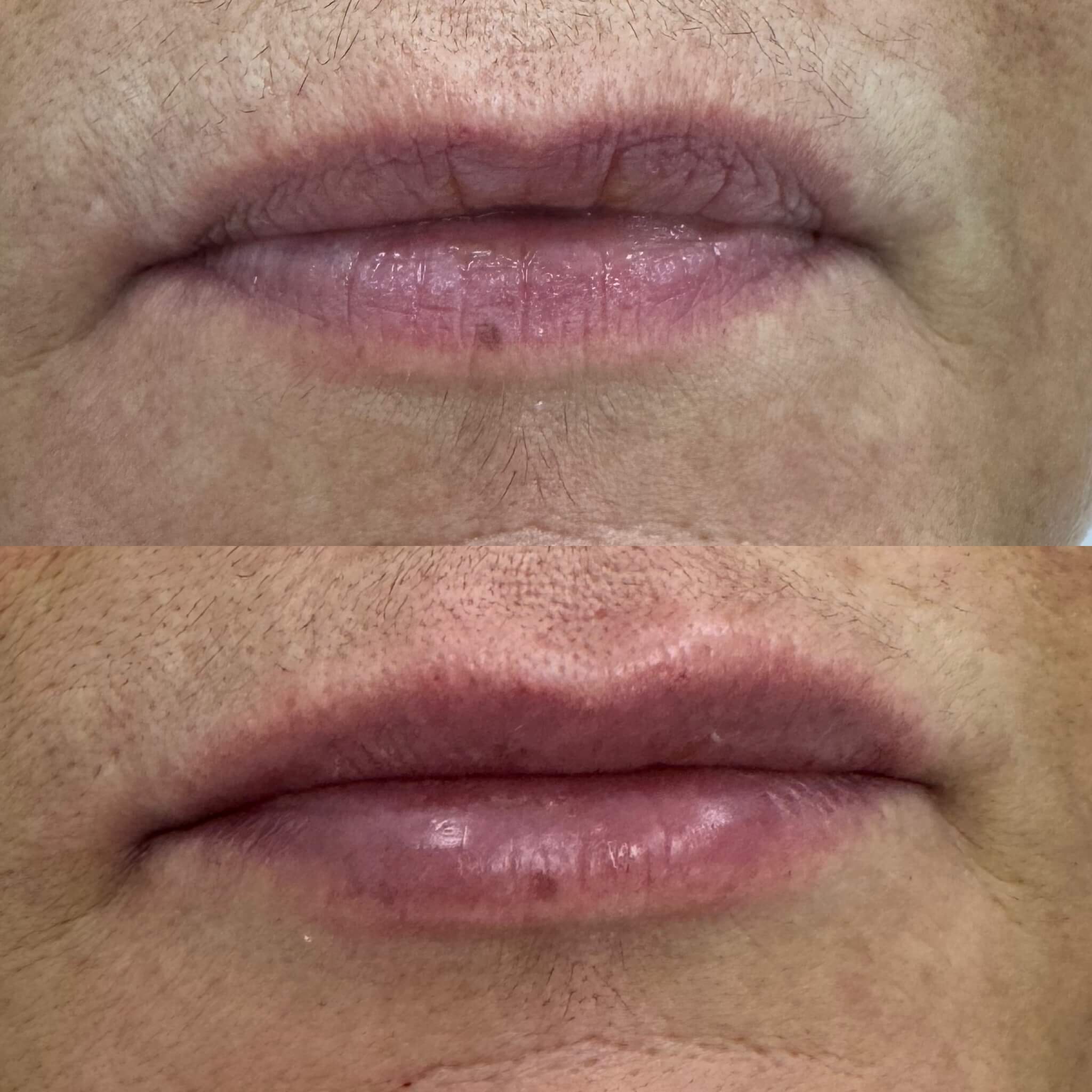 Увеличение губ 01