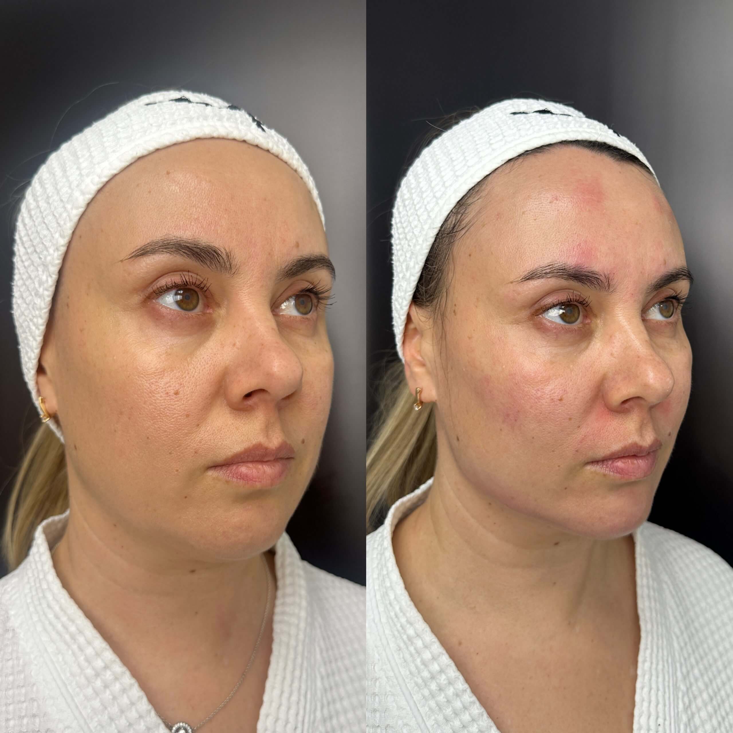 Контурная пластика лица 01