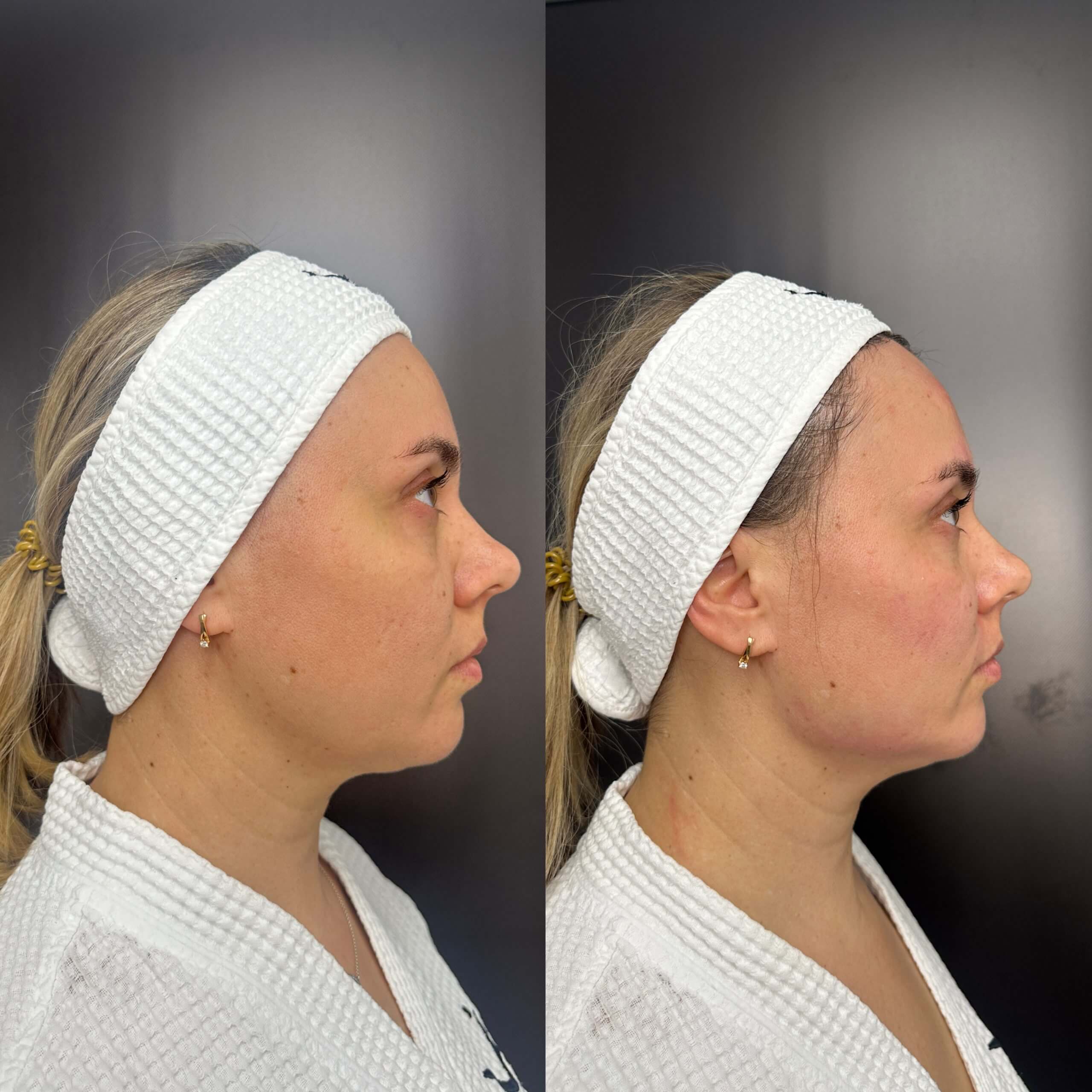 Контурная пластика лица 01