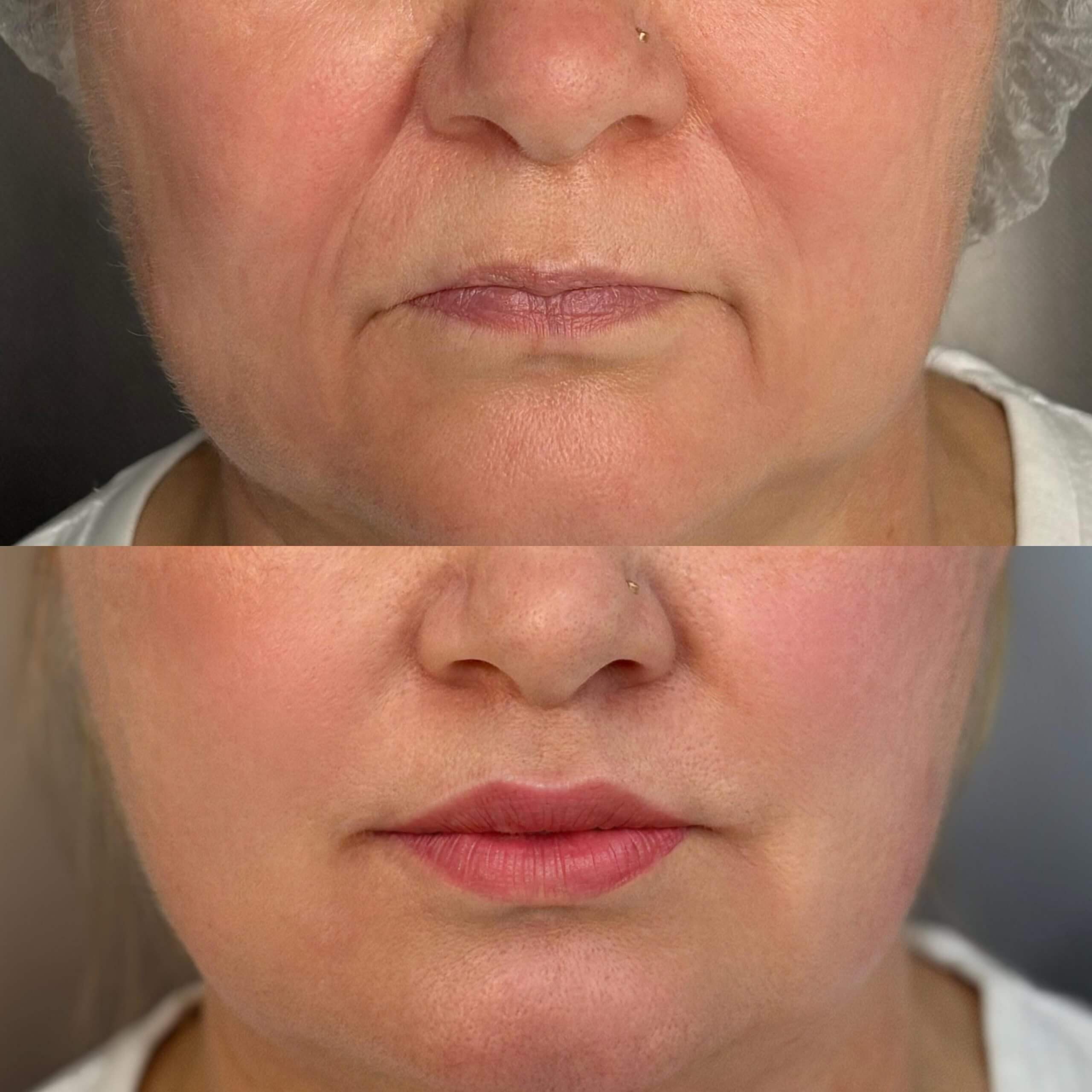 Увеличение губ 01