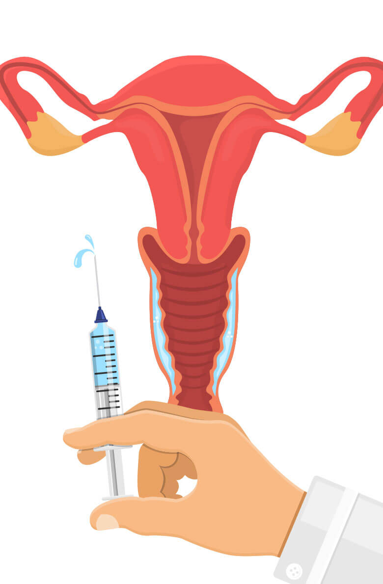 Интимное омоложение гиалуроновой кислотой