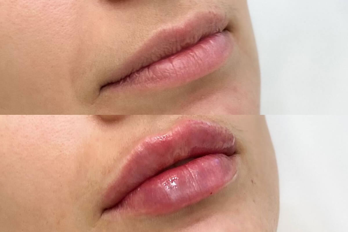 Увеличение губ 01