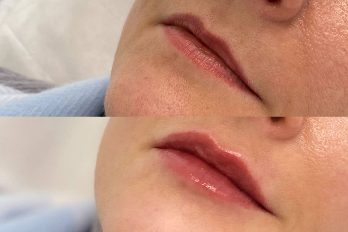 Увеличение губ 01