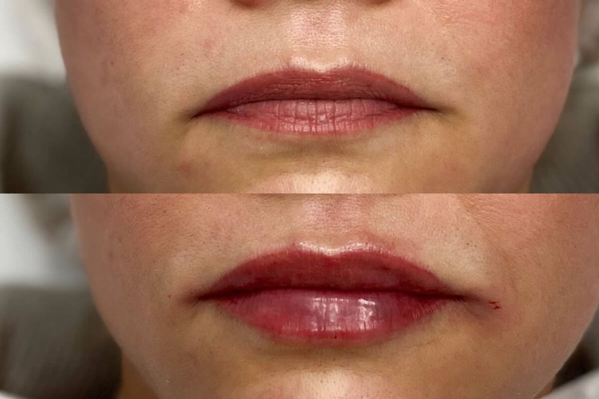 Увеличение губ 01