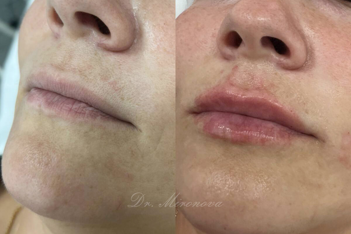 Увеличение губ 01