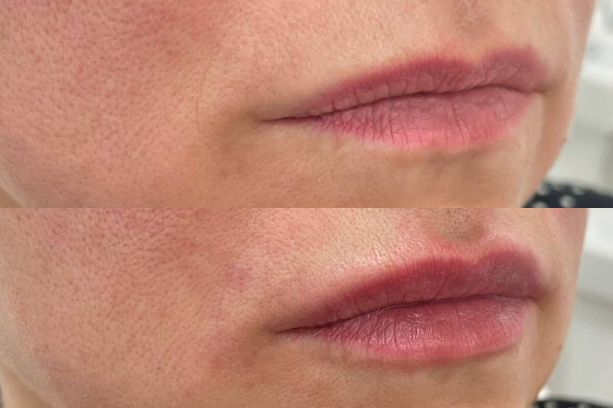 Увеличение губ 01