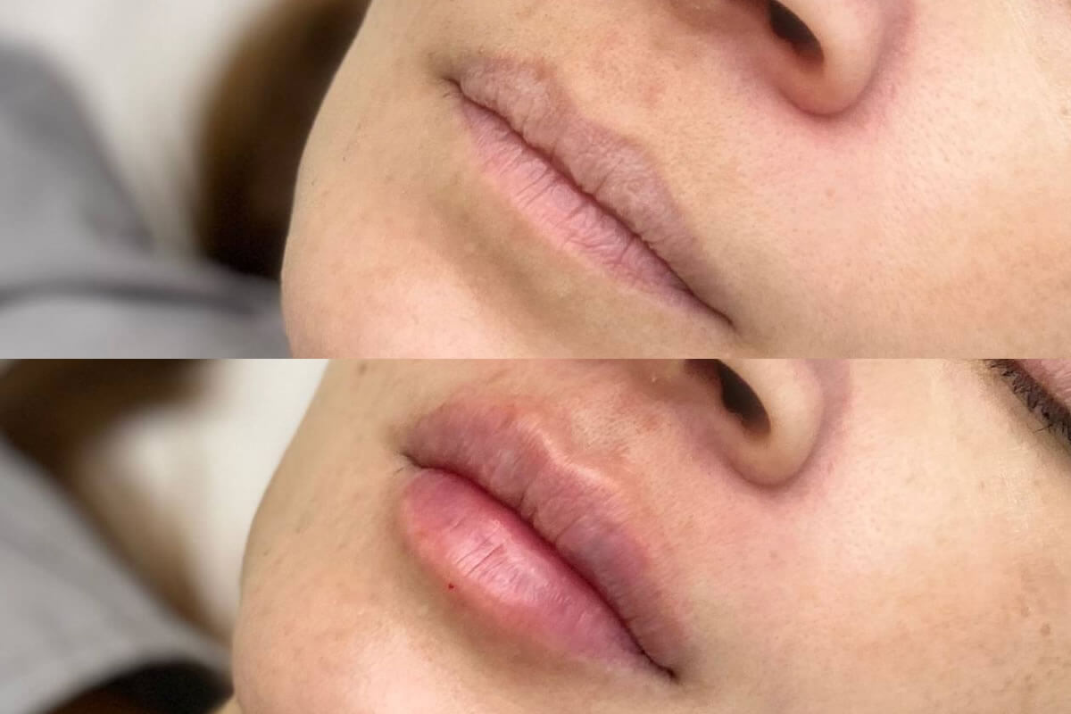 Увеличение губ 01