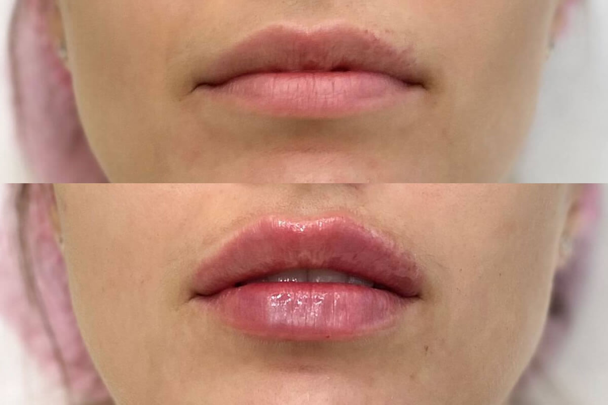 Увеличение губ 01