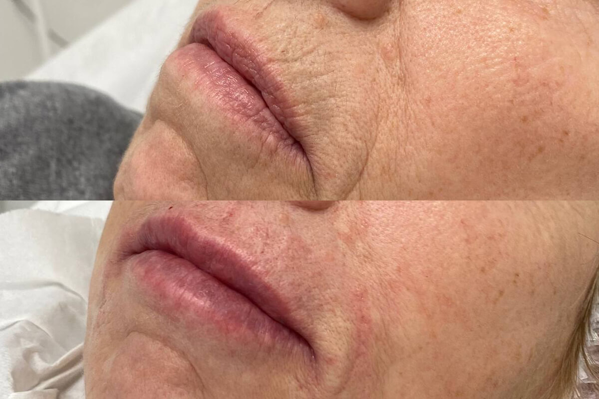 Увеличение губ 01