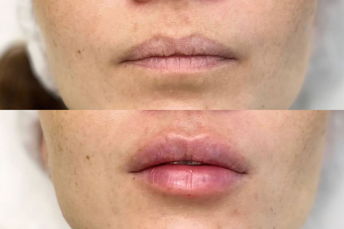 Увеличение губ 01