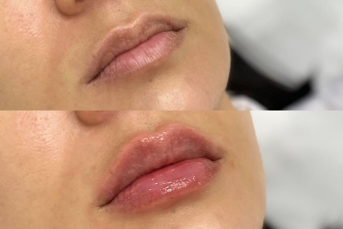 Увеличение губ 01