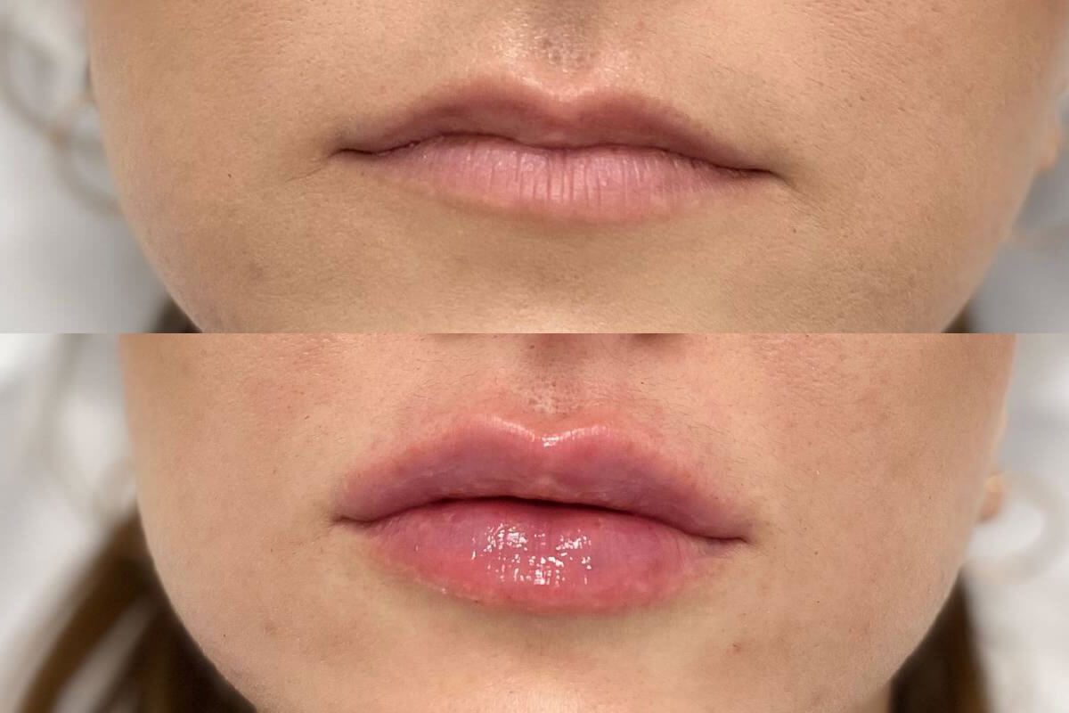 Увеличение губ 01