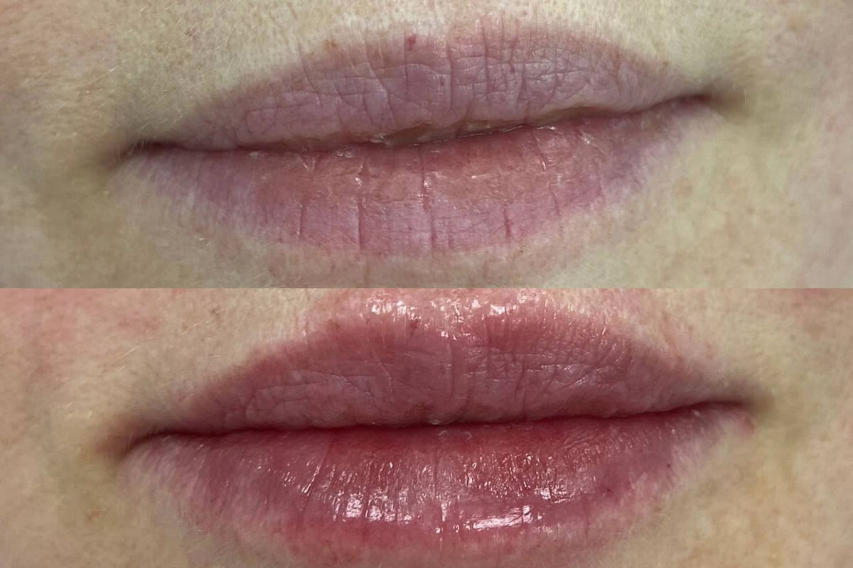 Увеличение губ 01