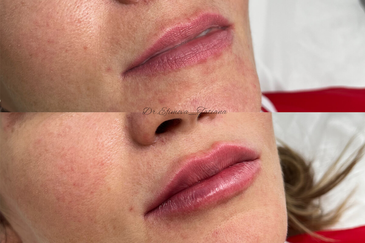 Увеличение губ 01