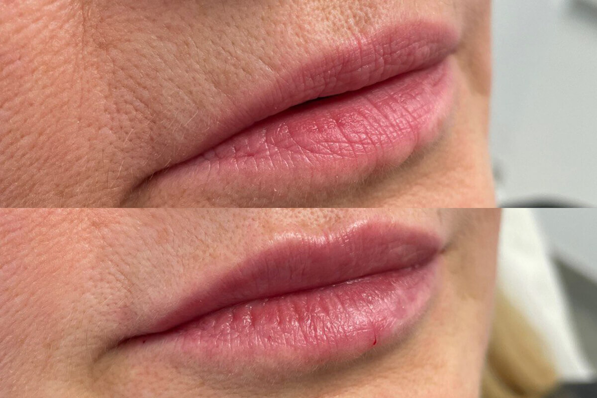 Увеличение губ 01