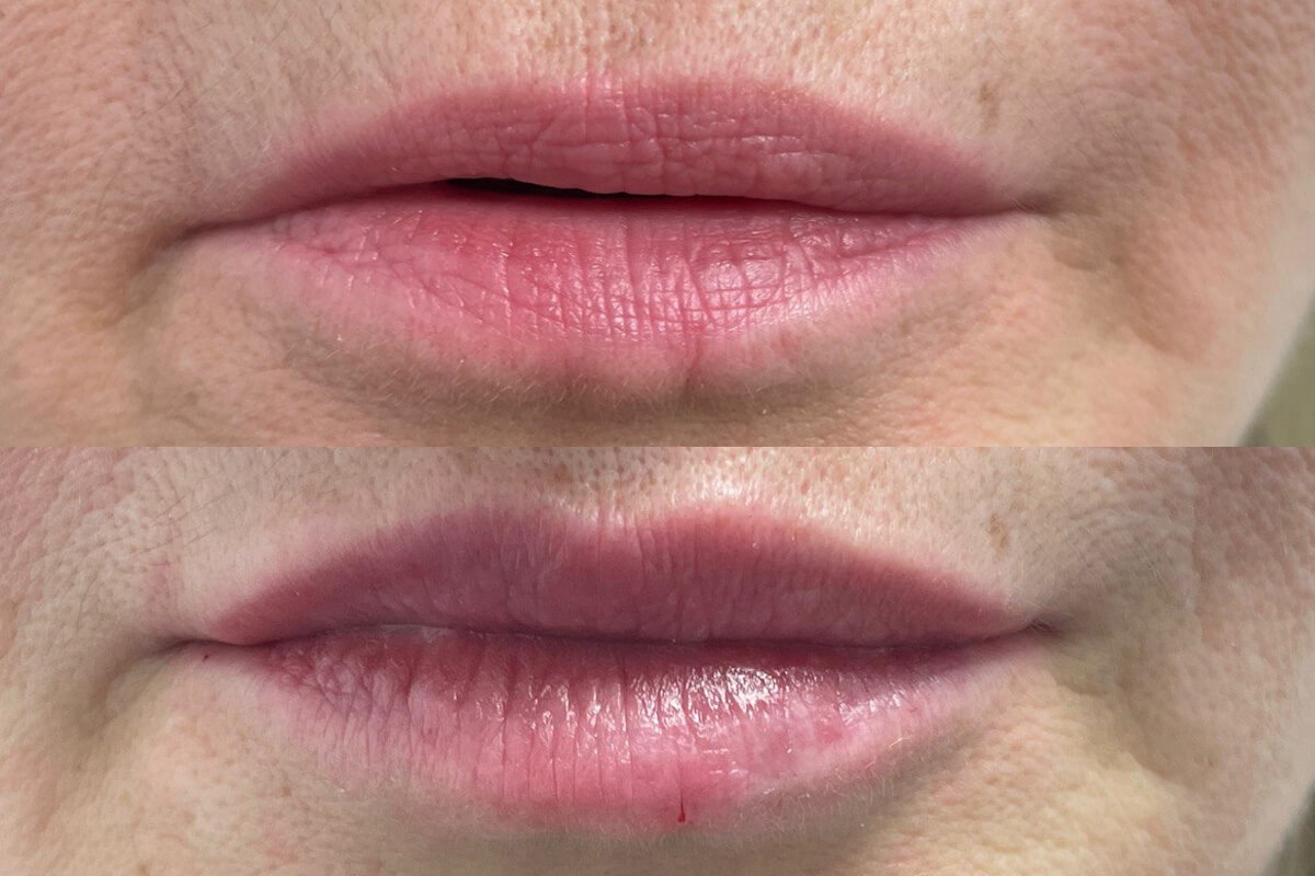 Увеличение губ 01