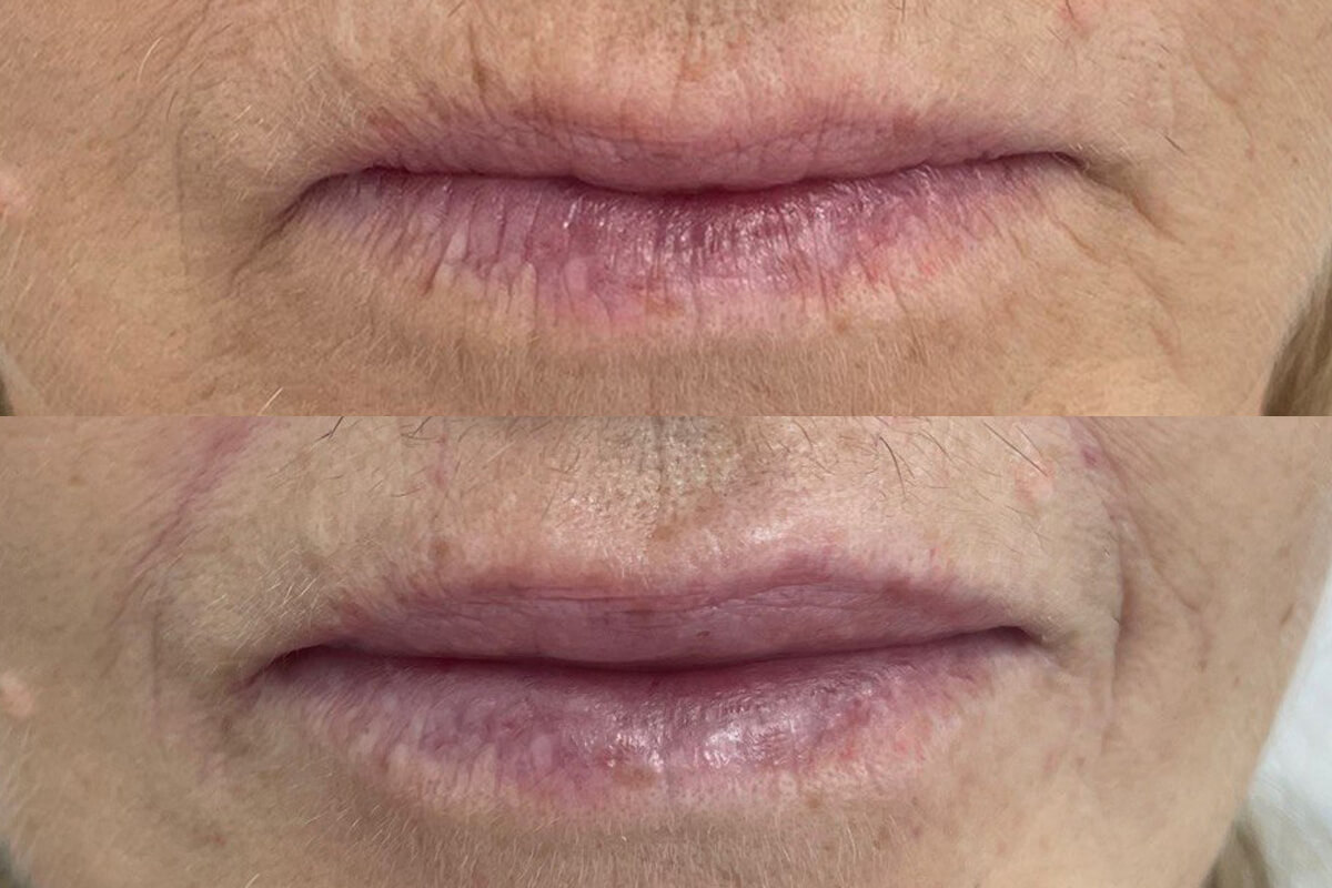 Увеличение губ 01