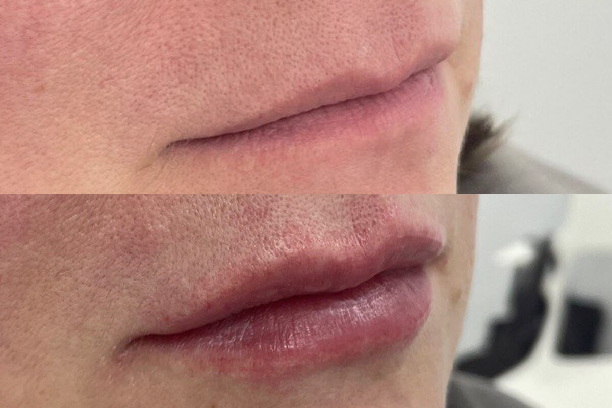 Увеличение губ 01