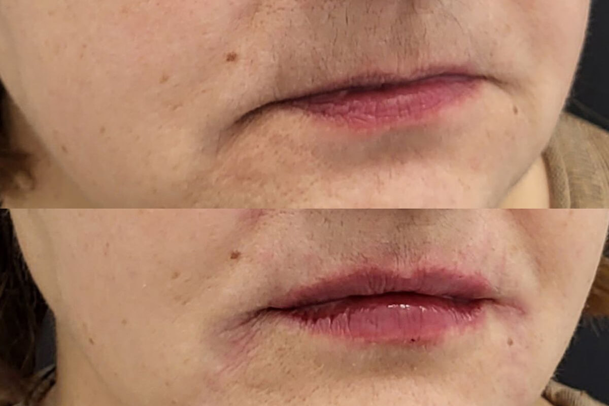 Увеличение губ 01