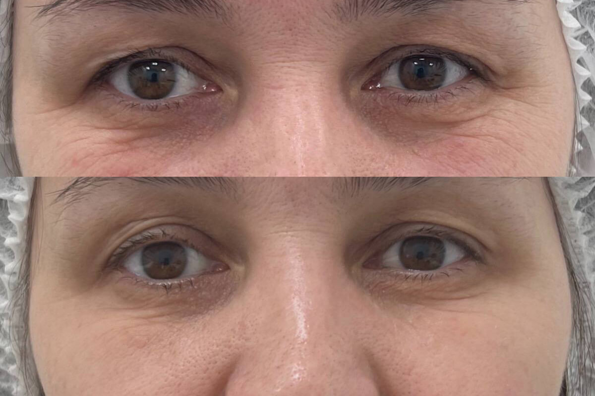 Ботулинотерапия 01