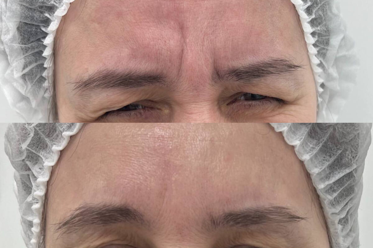 Ботулинотерапия 01