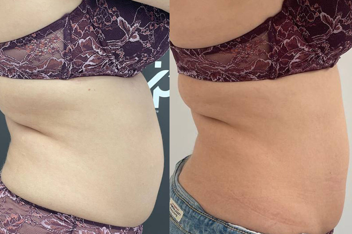 Криолиполиз Zeltiq 01