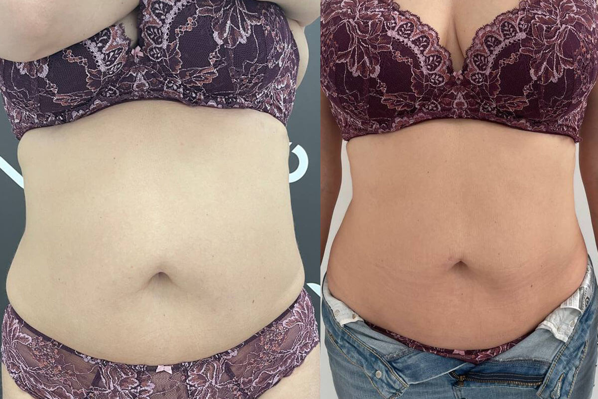 Криолиполиз Zeltiq 01