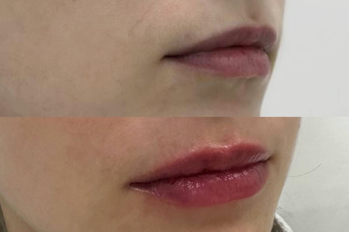 Увеличение губ 01