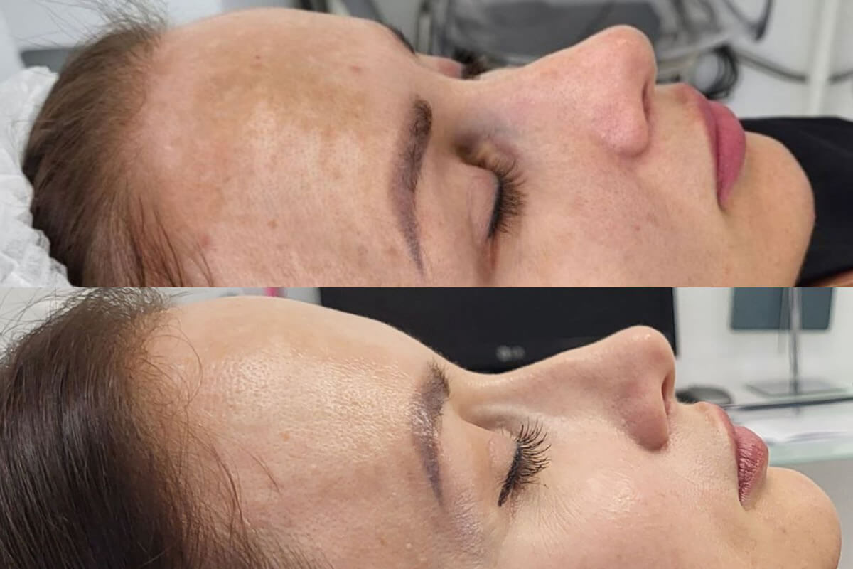 Удаление пигментации PicoSure 01