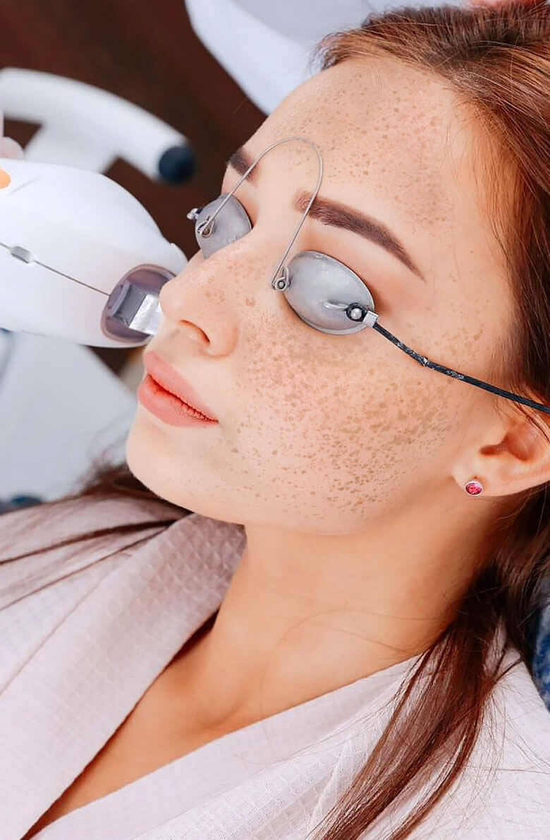 Лечение пигментации М22