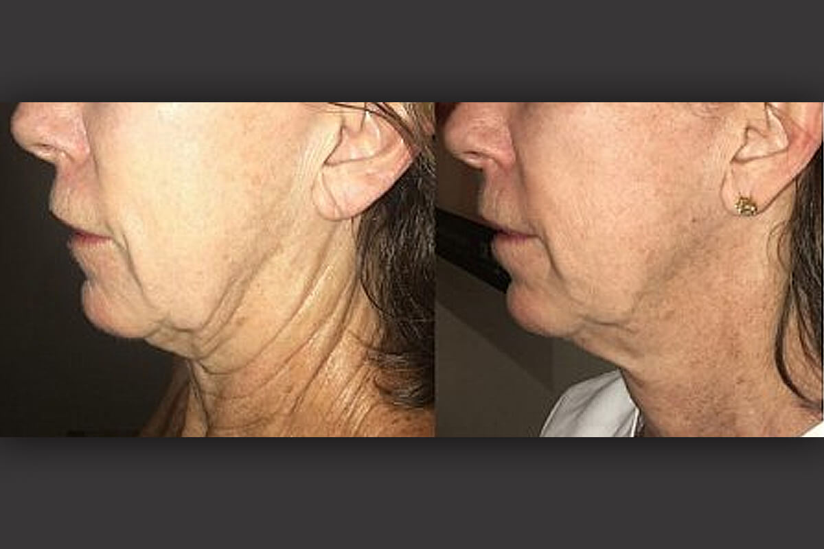 Микроигольчатый RF-лифтинг Morpheus 8 01