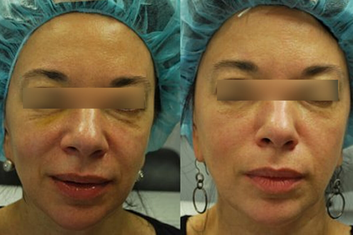 Микроигольчатый RF-лифтинг Morpheus 8 01